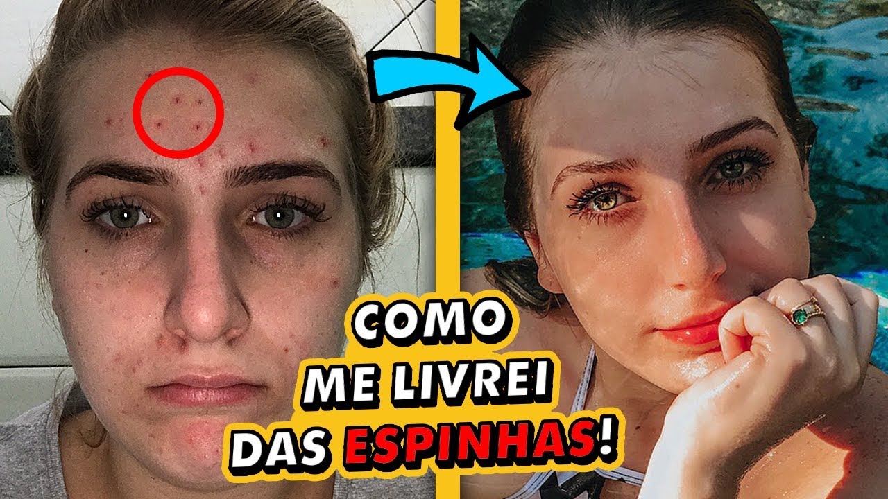 COMO ACABAR COM ESPINHAS! 😱 Rotina de Cuidados com a Pele +  Minha Experiência!