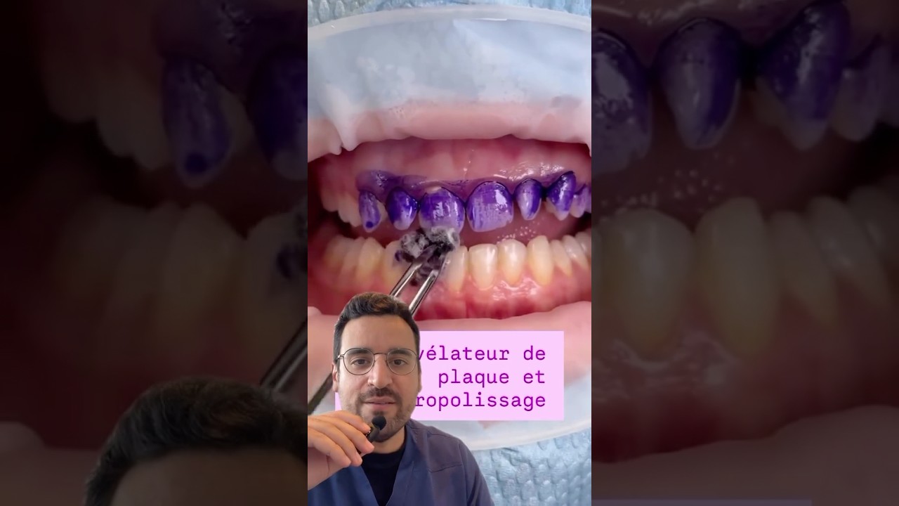 Révélateur de plaque dentaire + aéro-polisseur, le duo gagnant !