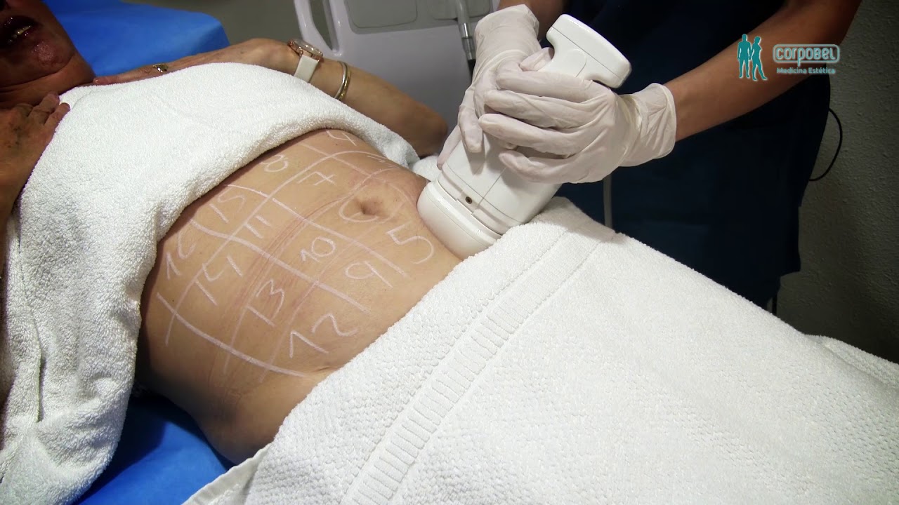 Tratamiento Reductor Hifu, Ultrasonidos Focalizados Alta Intensidad Corpobel Salamanca