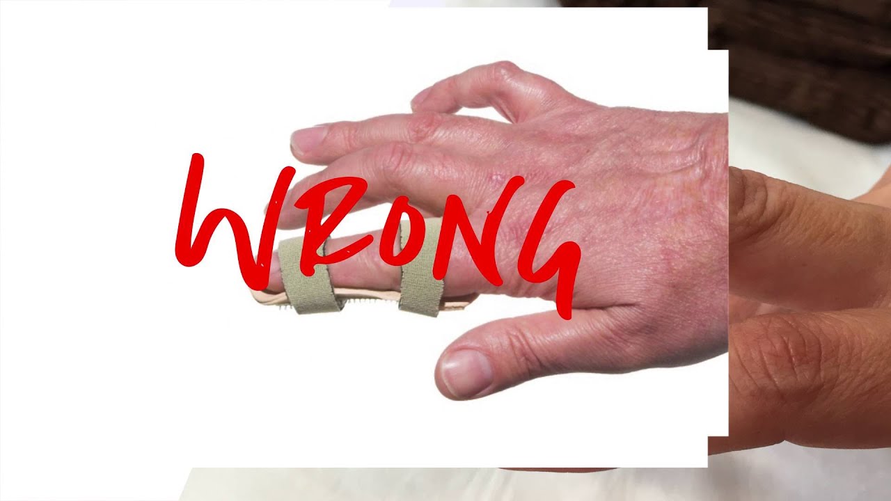 Mallet Finger Treatment