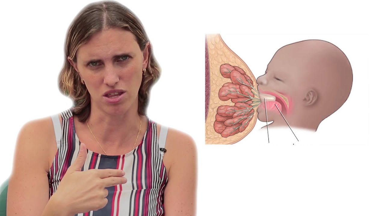 Conductos tapados y mastitis, Dra. Nicole Zaltzman, Pediatra Certificada en Lactancia Materna