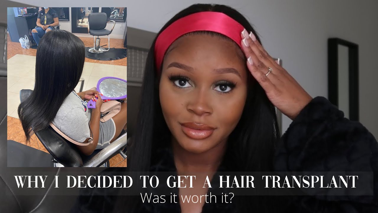Why I decided to get a hair transplant | Pictures Included