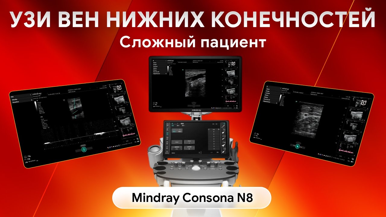 Как Mindray Consona N8 справляется с УЗИ вен нижних конечностей у тучных пациентов?