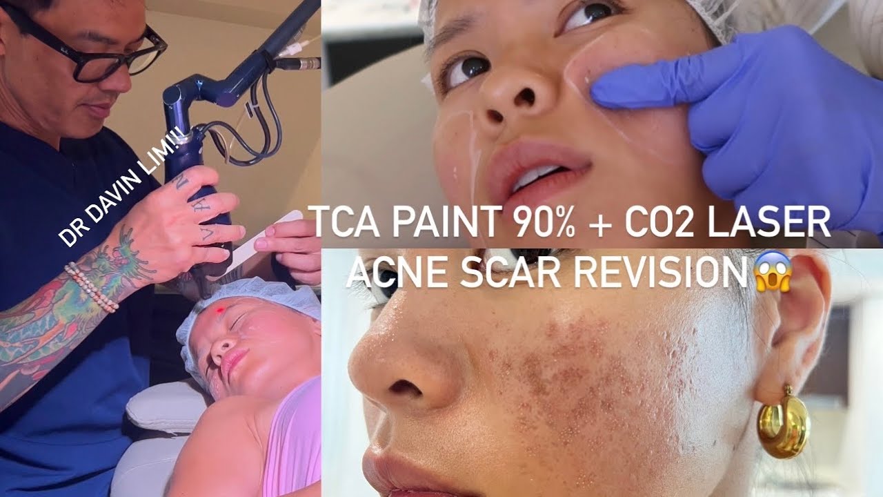 ACNE SCAR REVISION- TCA PAINT 90% + CO2 Laser with Dr Davin Lim