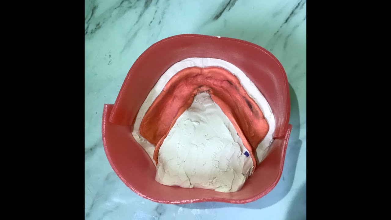 Encajonado para Prótesis Total