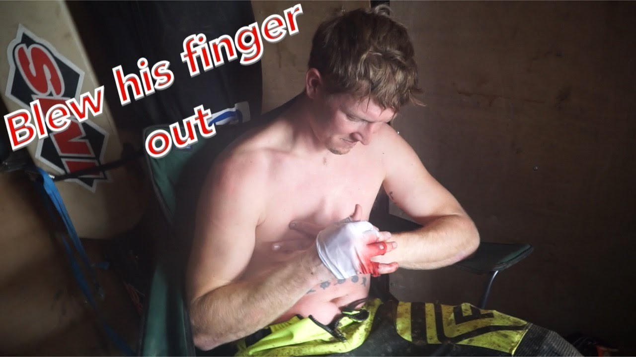 SMASHED HIS FINGER AND STILL FINISHED!!