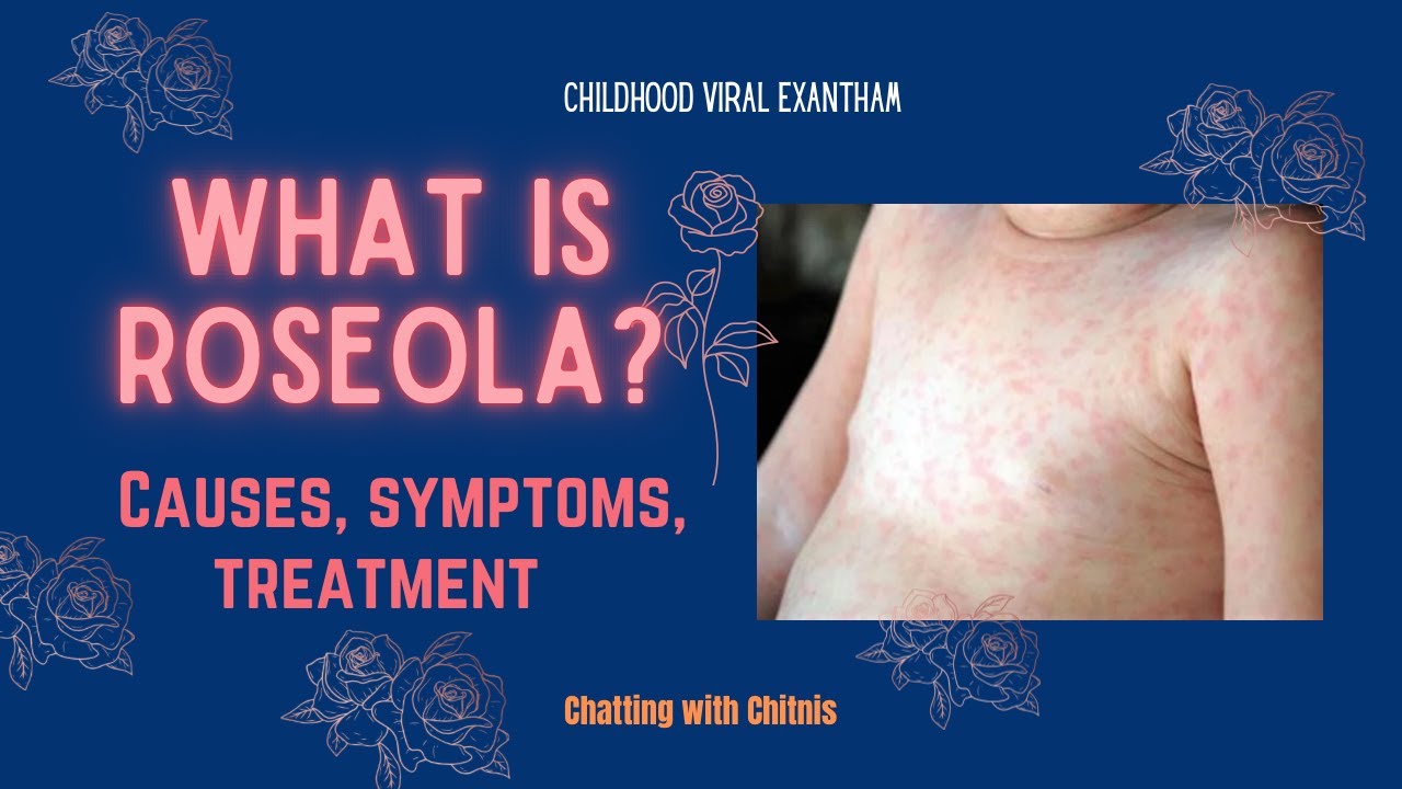 Roseola in your Child