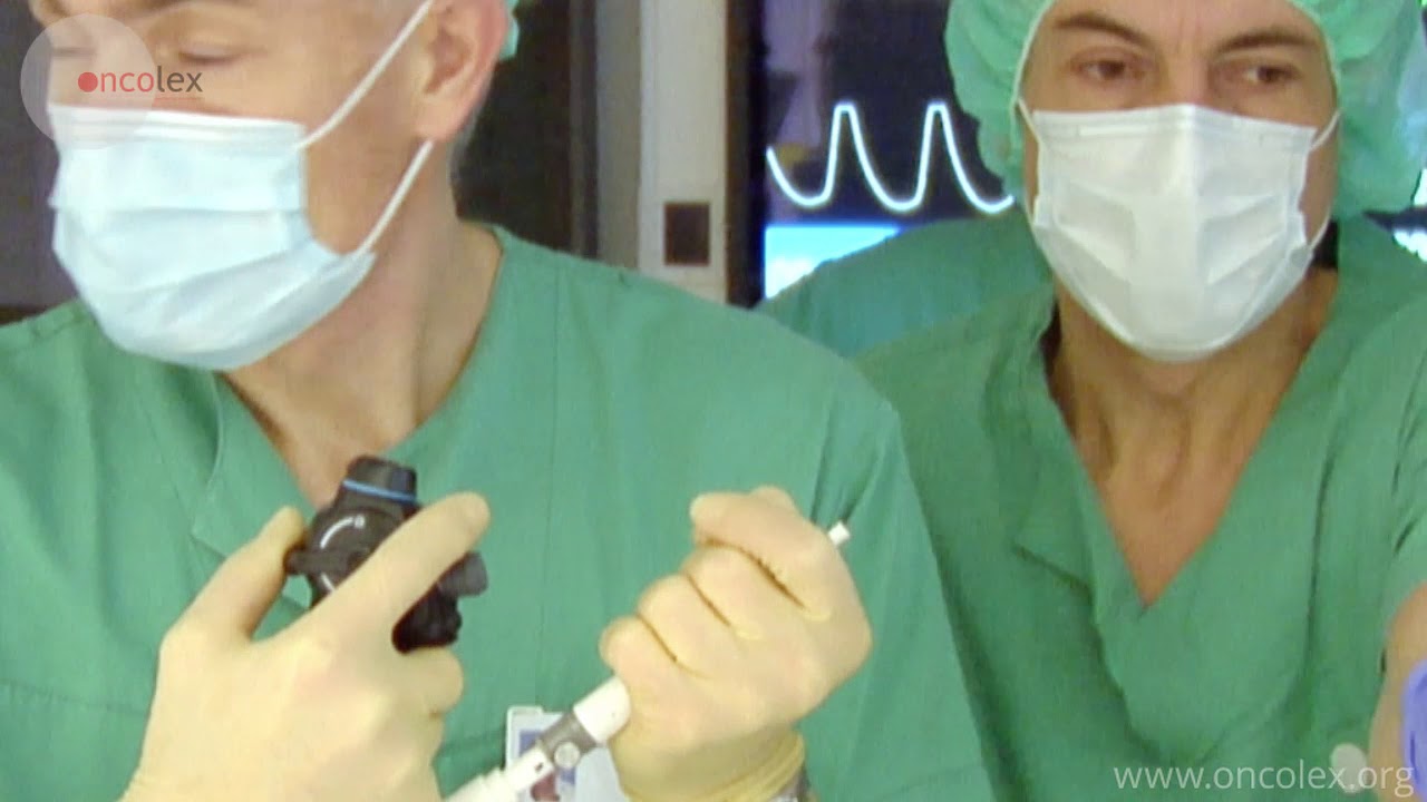 Endobronchial ultrasound bronchoscopy with needle biopsy