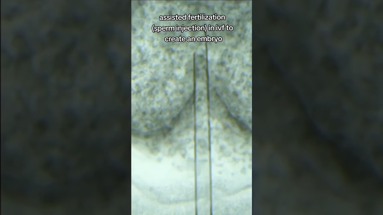 sperm injection or icsi revolutionized ivf to overcome human infertility