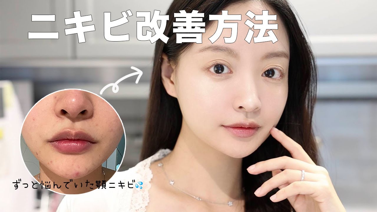 美容皮膚科に無駄使いは🙅&zwj;♀️ Qoo10で人気のあの商品を使った私だけのニキビ改善方法❤️