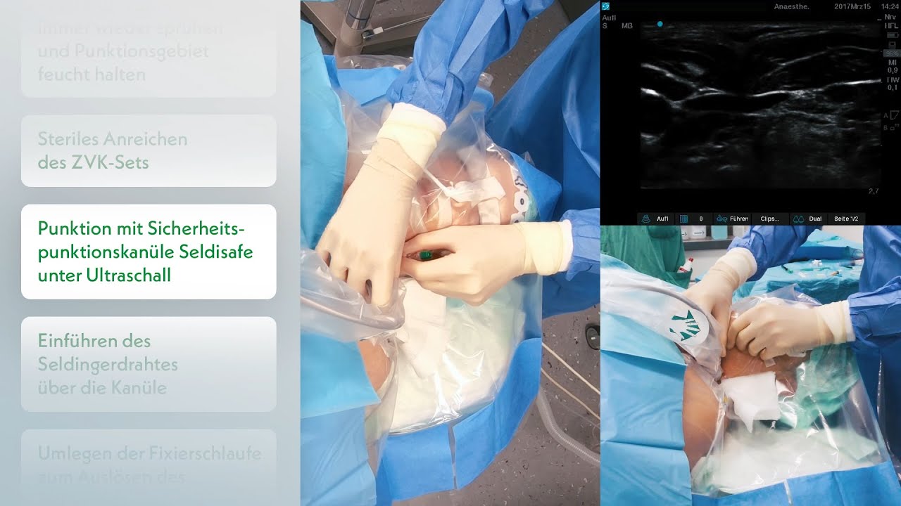 Zentralvenöse Katheter Anlage gemäß RKI Empfehlung – ZVK Platzierung