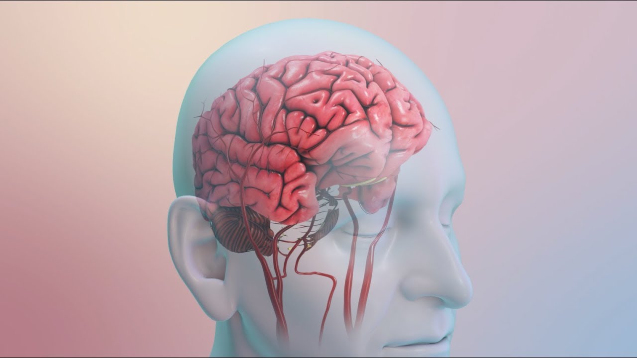 What Causes a Stroke?