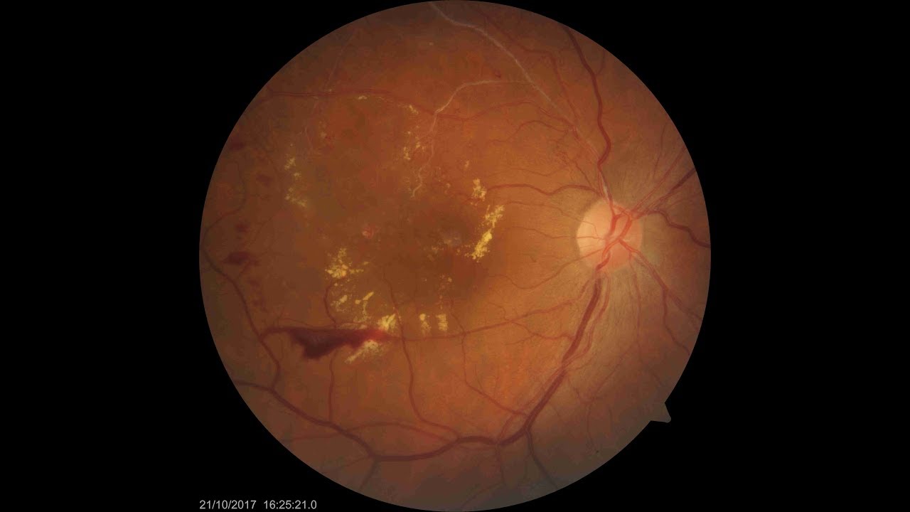 Treatment for Retinal Vein Occlusion