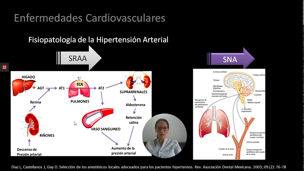 Manejo Paciente Hipertenso en Odontología