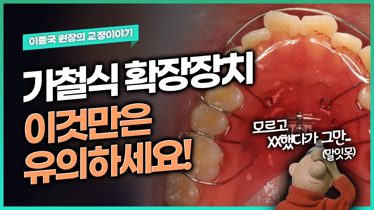 가철식(꼈다뺐다하는) 상악 확장장치, 악궁 확장 장치에 대해 알아보겠습니다.