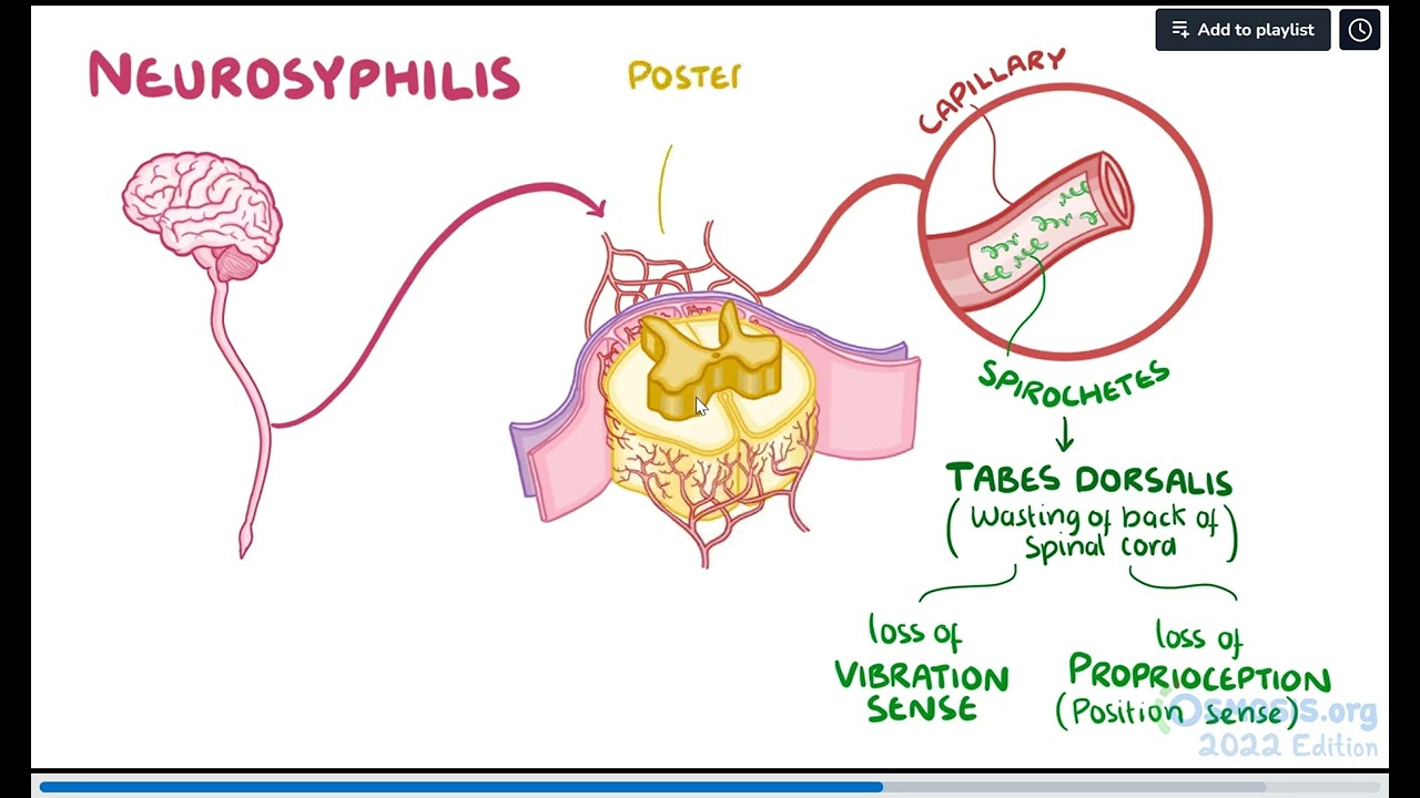 Treponema pallidum (Syphilis)