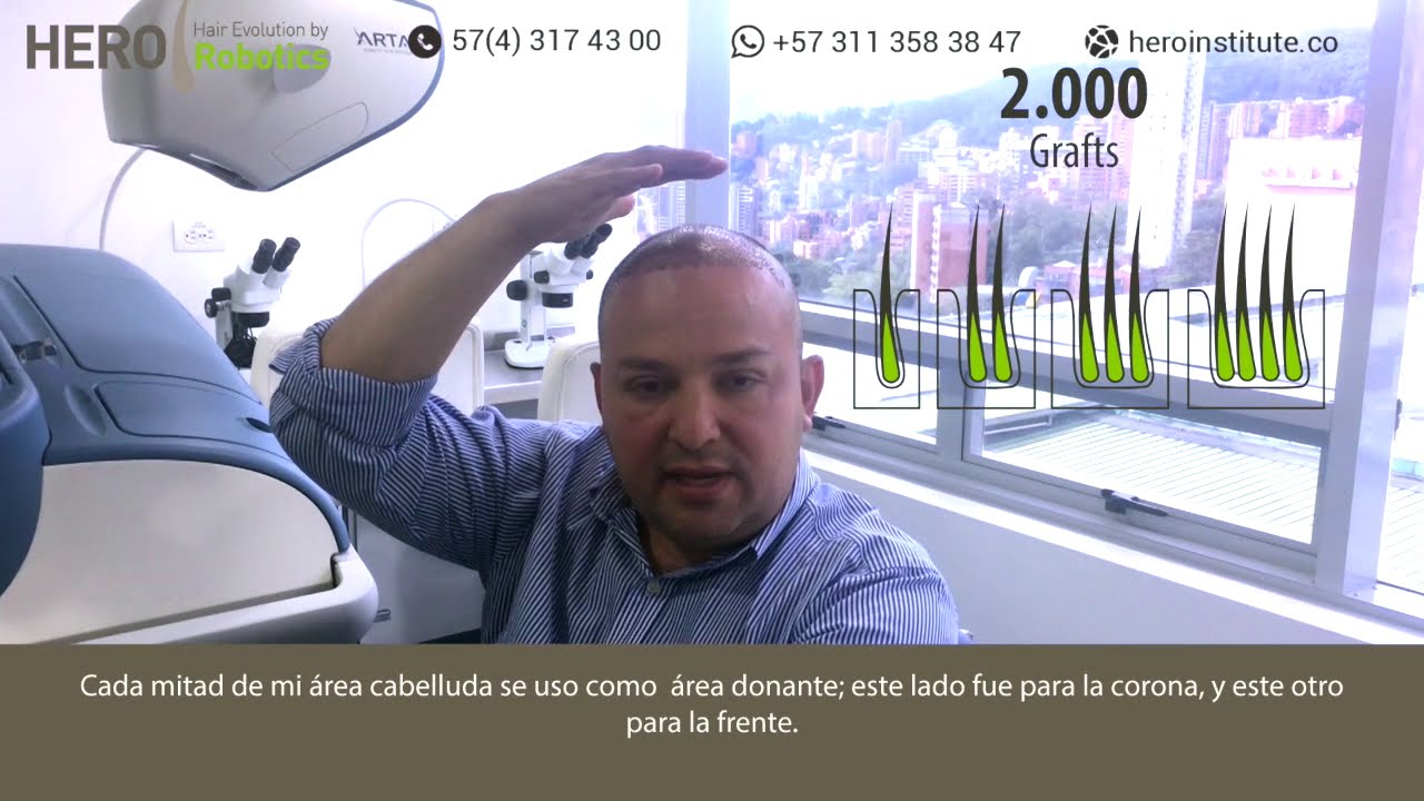 Un paciente con dos trasplantes capilares robóticos realizados en una semana, robot ARTAS en acción.