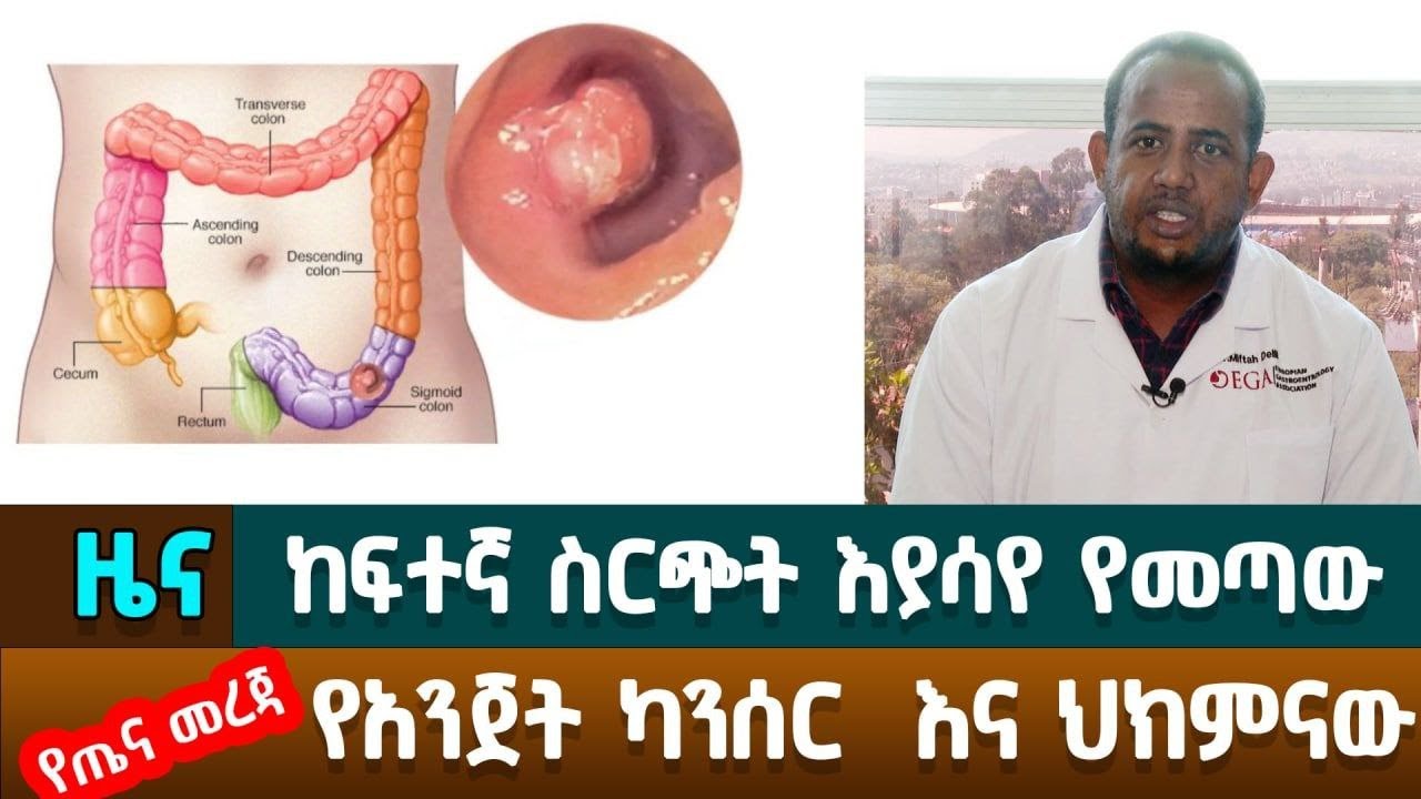 ከፍተኛ ስርጭት እያሳየ የመጣው የአንጀት ካንሰር እና ህክምናው