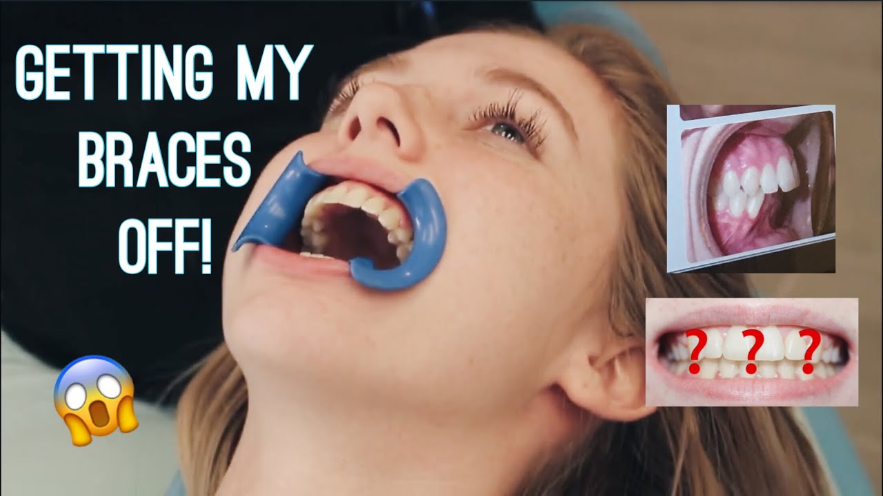 GETTING MY BRACES OFF VLOG