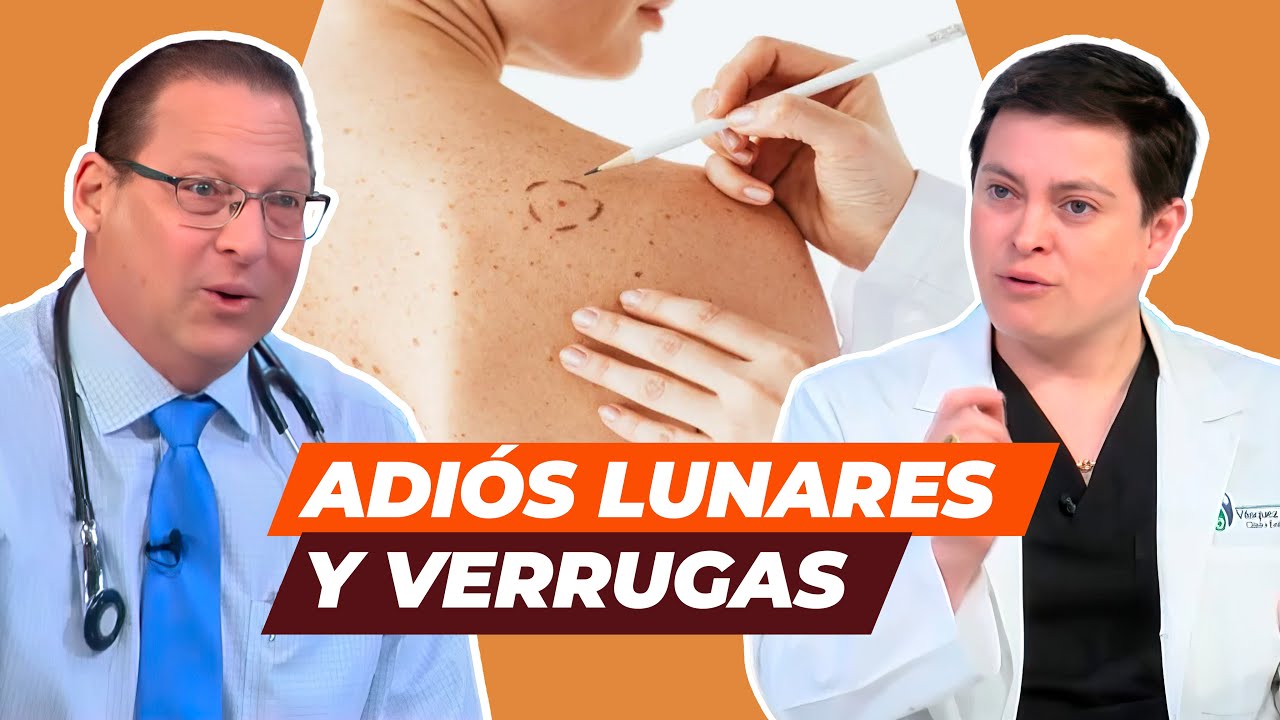 La mejor forma de eliminar los lunares y verrugas –Clínica estética en Lima, Perú