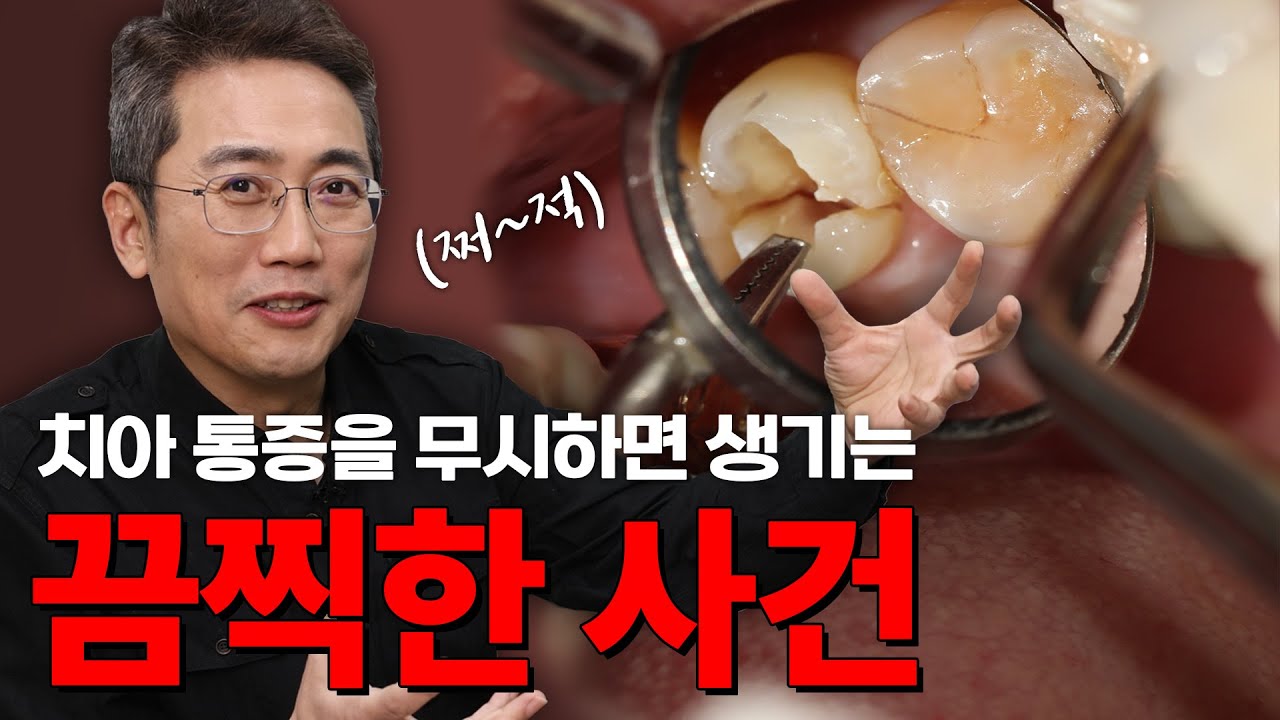 금이 간 치아를 방치하면 생기는 일 ㅣ 치아파절, 치아균열, 치아깨짐