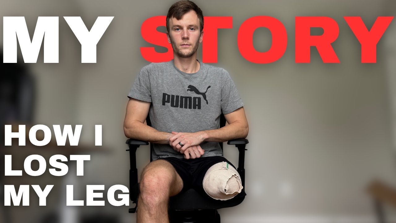 How I Lost My Leg - The Full Story