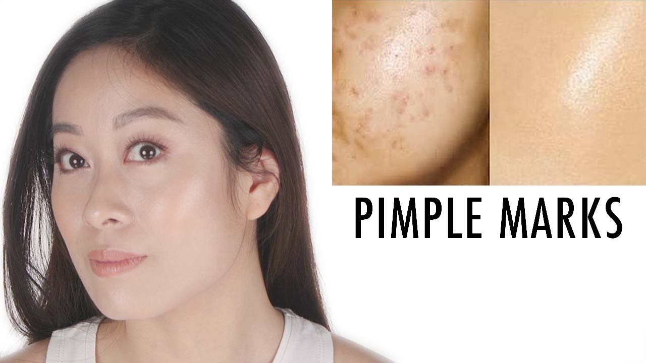 How To Get Rid of Breakout Marks | Acne Spots | Vivienne Fung