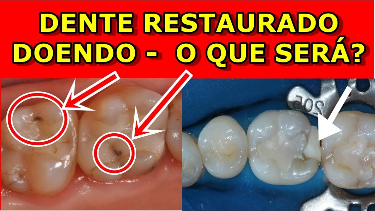 Dente Restaurado Doendo - O que pode ser? O que fazer?