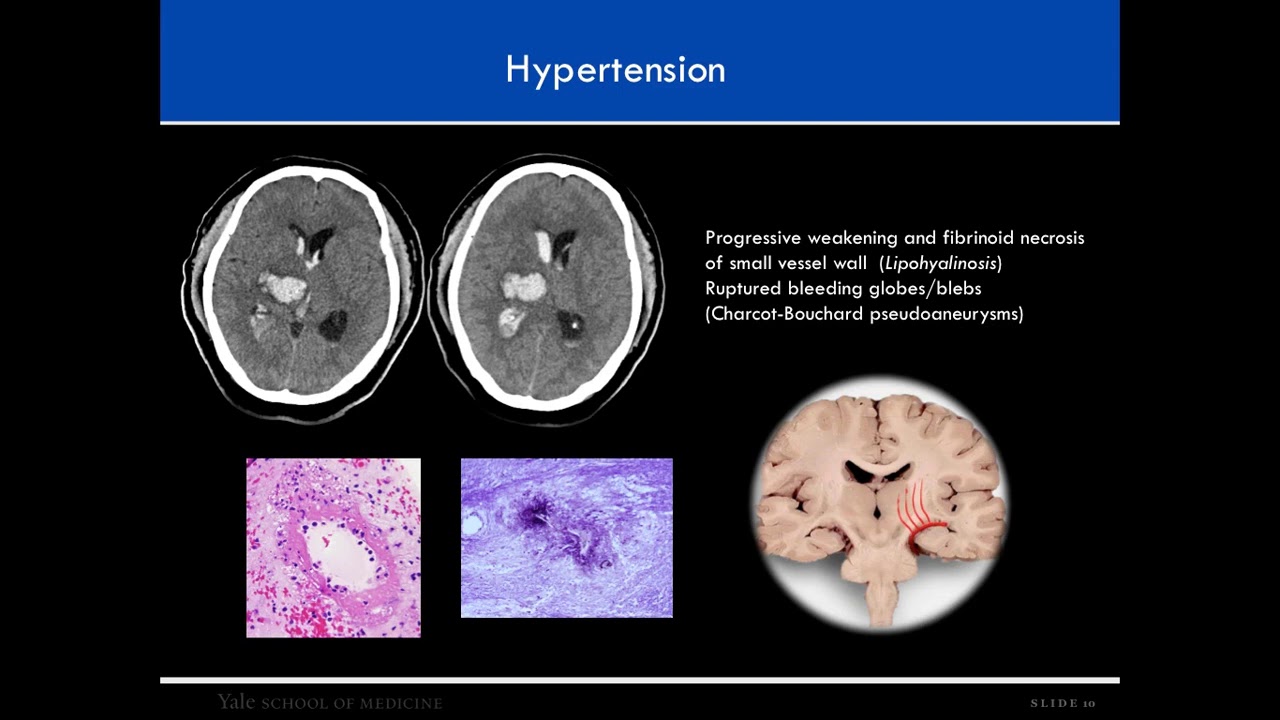 HEMORRAGIA INTRACRANEAL NO TRAUMÁTICA  (CURSO DE NEURORRADIOLOGIA * 2 * )