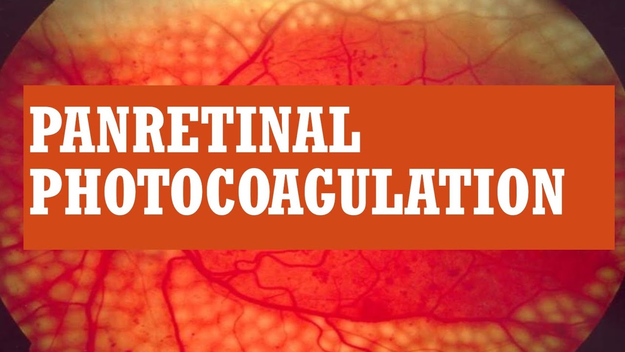 LASER TREATMENT FOR DIABETIC RETINOPATHY || PAN RETINAL PHOTOCOAGULATION ( PRP)