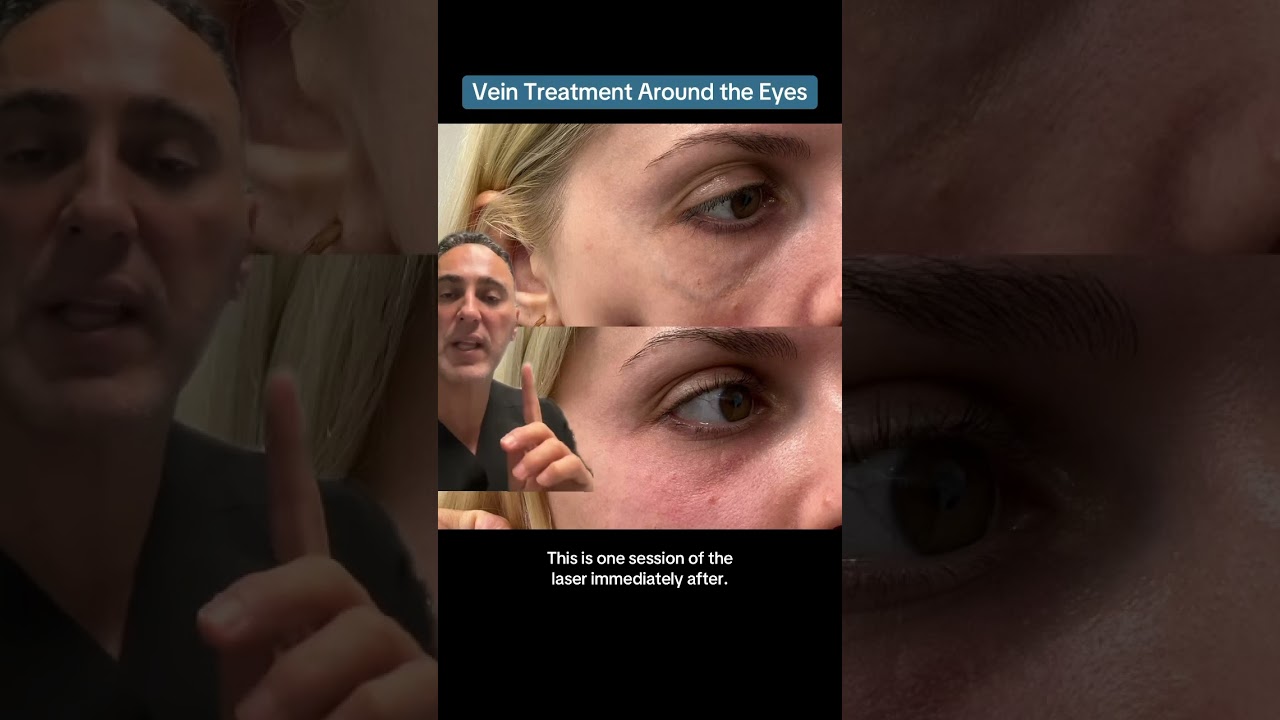 Vein Treatment Around the Eyes
