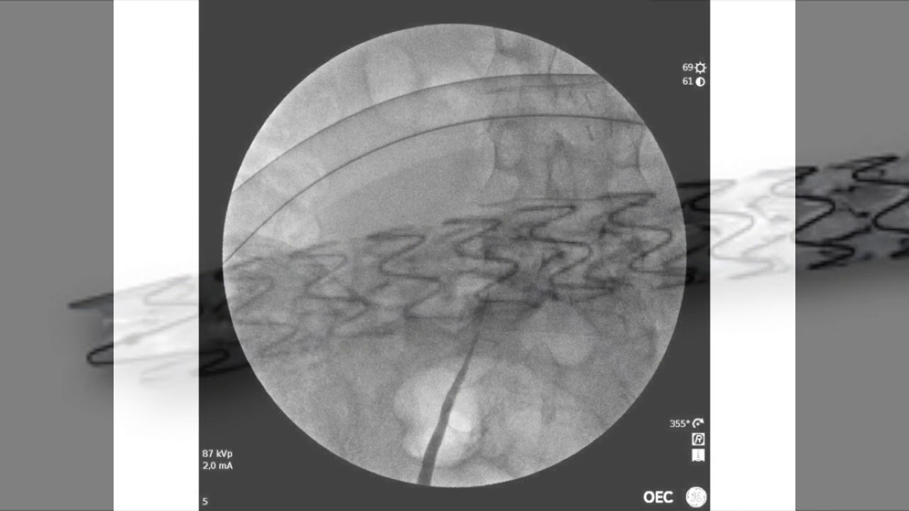 Retroperitoneal Fibrosis