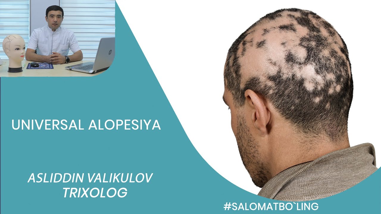Soch to’kilishi-UNIVERSAL ALOPESIYA.SHIFOKOR TRIXOLOG MASLAXATI.Алопеция ҳақида ўзбекчада маълумот