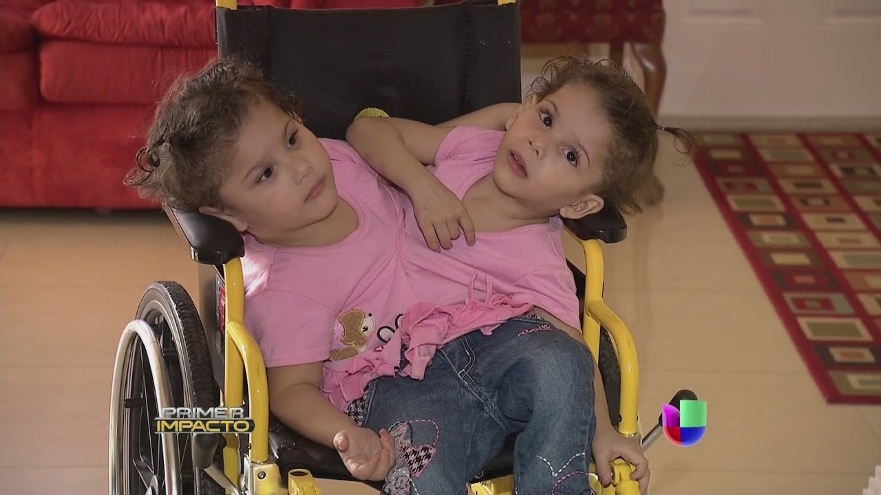 Siamesas hondureñas están unidas por el torso y por el amor - Primer Impacto