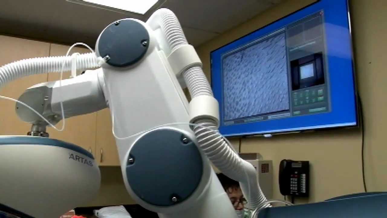 Przeszczep włosów FUE - ARTAS - robot do przeszczepu włosów