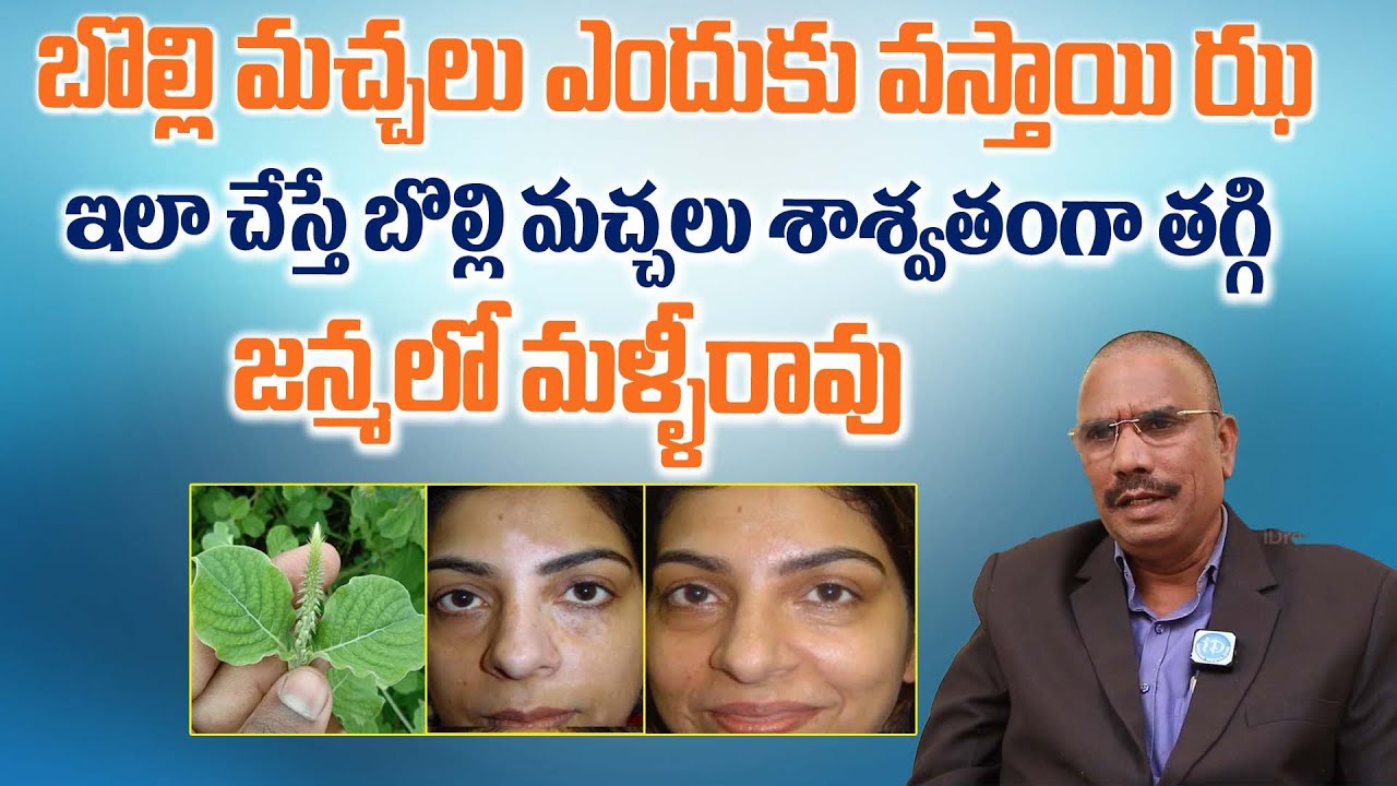 ముఖం మీద ఇలాంటి మచ్చలు తగ్గాలంటే ? Bolli Machalu | Vitiligo | Health Tips In Telugu |iDream Aarogyam