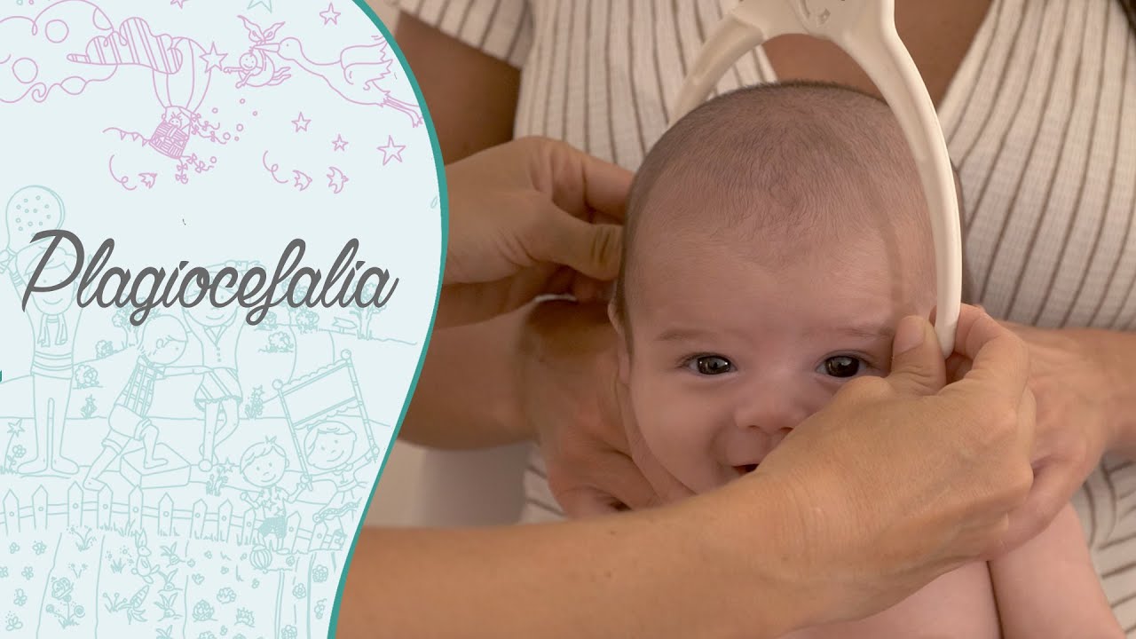 Tortícolis y/o plagiocefalia. ¿Qué son y cómo tratarlas?