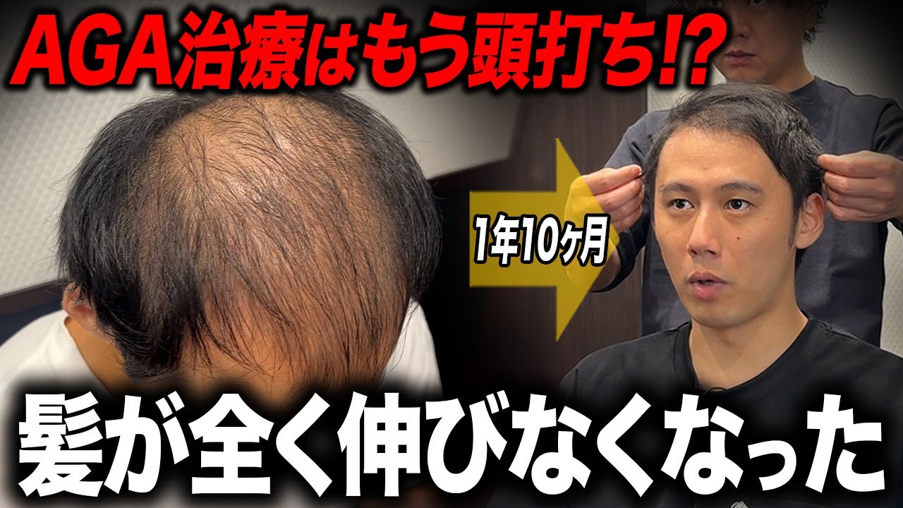 【本当に限界】AGA治療1年10ヶ月で効果の頭打ちに直面...。