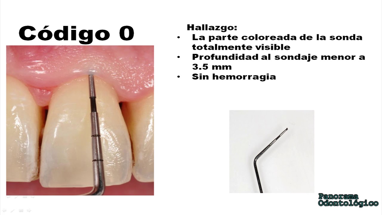 Examen Periodontal Básico