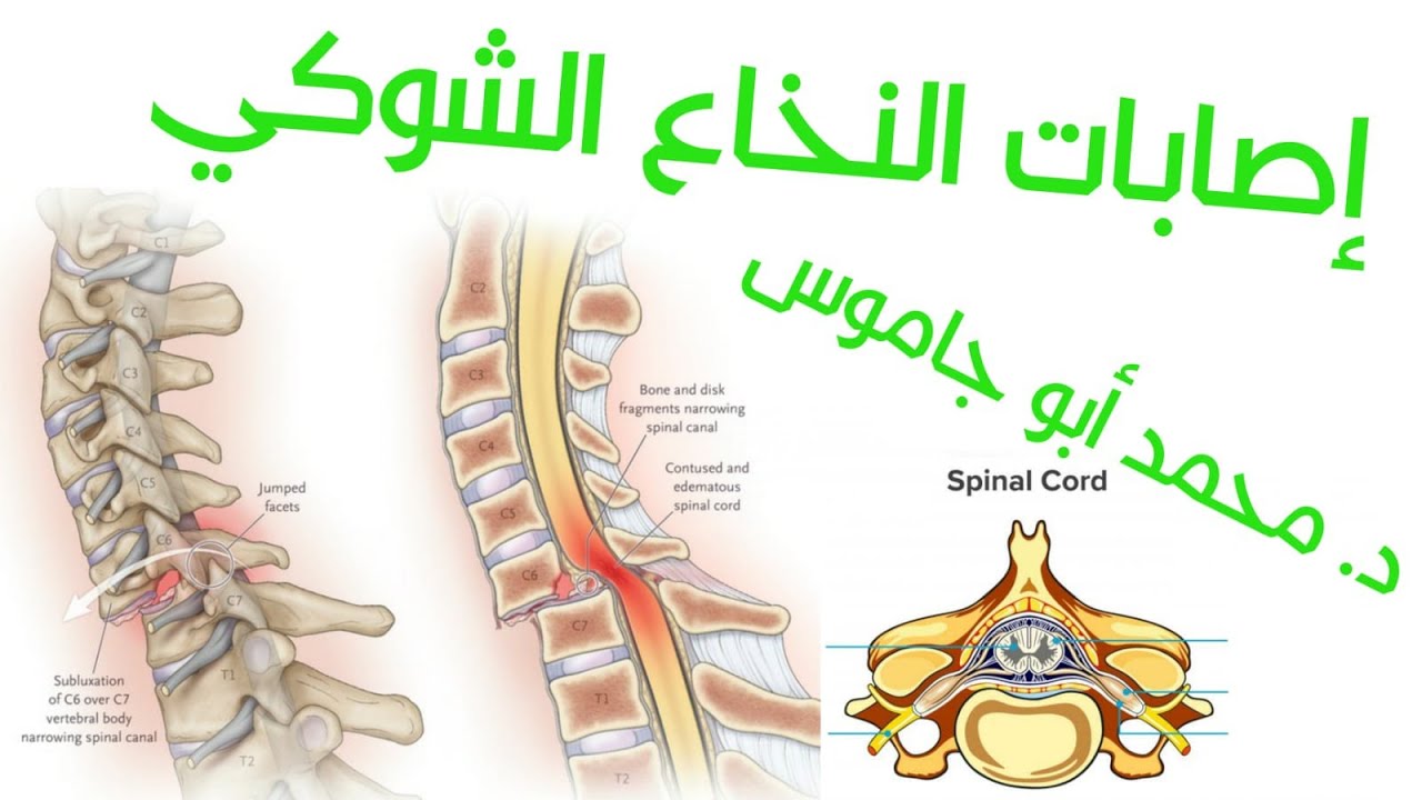 أنواع إصابات النخاع الشوكي الدكتور محمد أبو جاموس