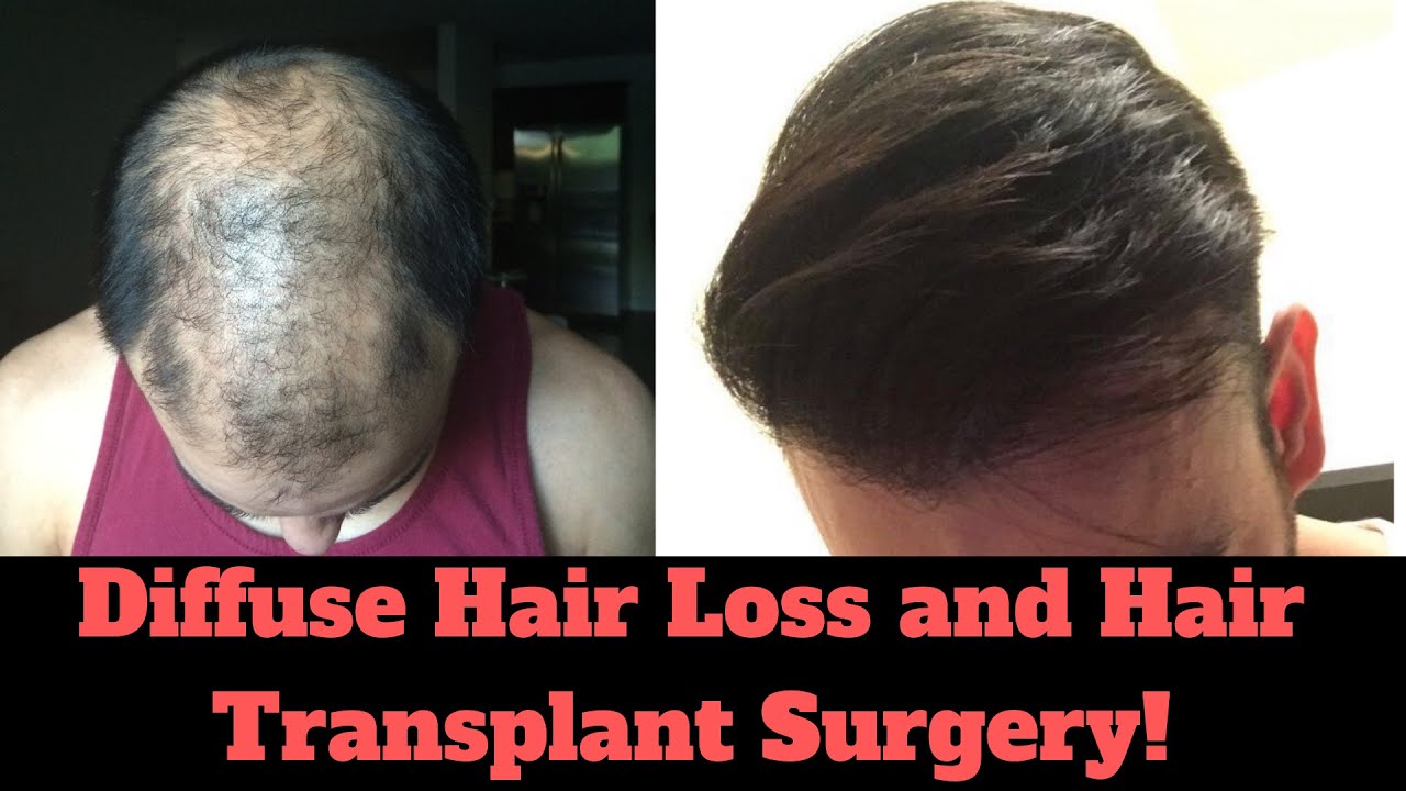 ❓Can you have a Hair Transplant with Diffuse Hair Loss?