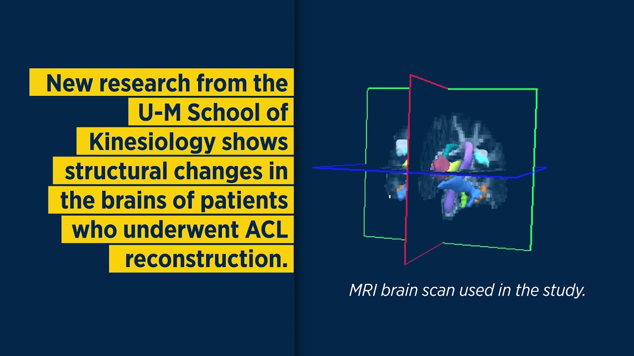 University of Michigan research finds ACL tears cause harmful changes in our brain structure