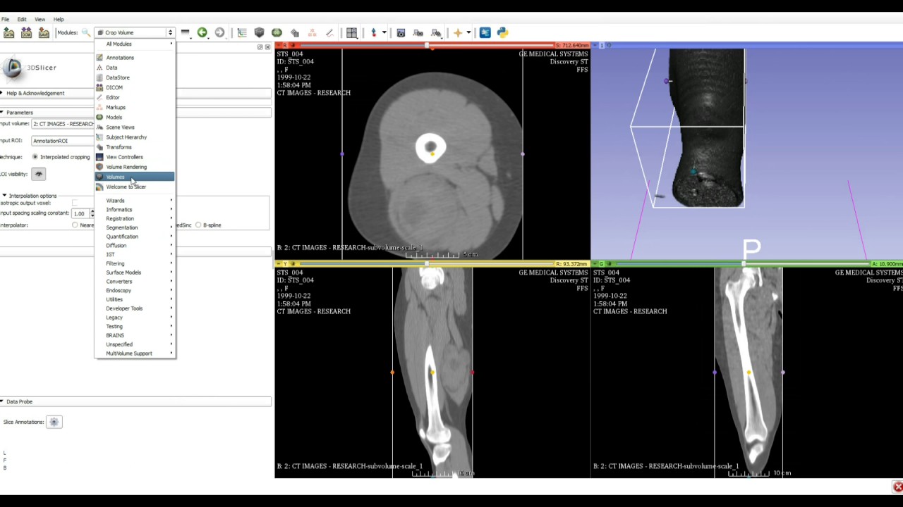 Creating Lifelike Muscle and Skin 3D Printable STL Files from Medical CT Scans Using a Free Service