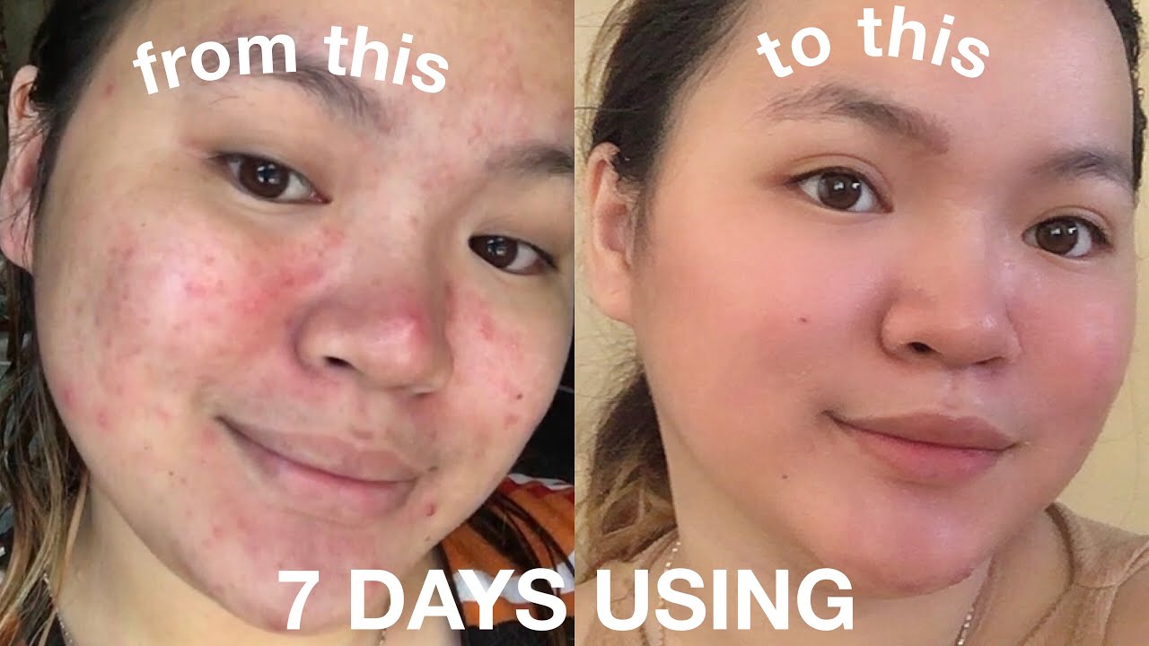 7 DAYS USING FAIRY SKIN DERMA FACIAL SET (HONEST REVIEW)