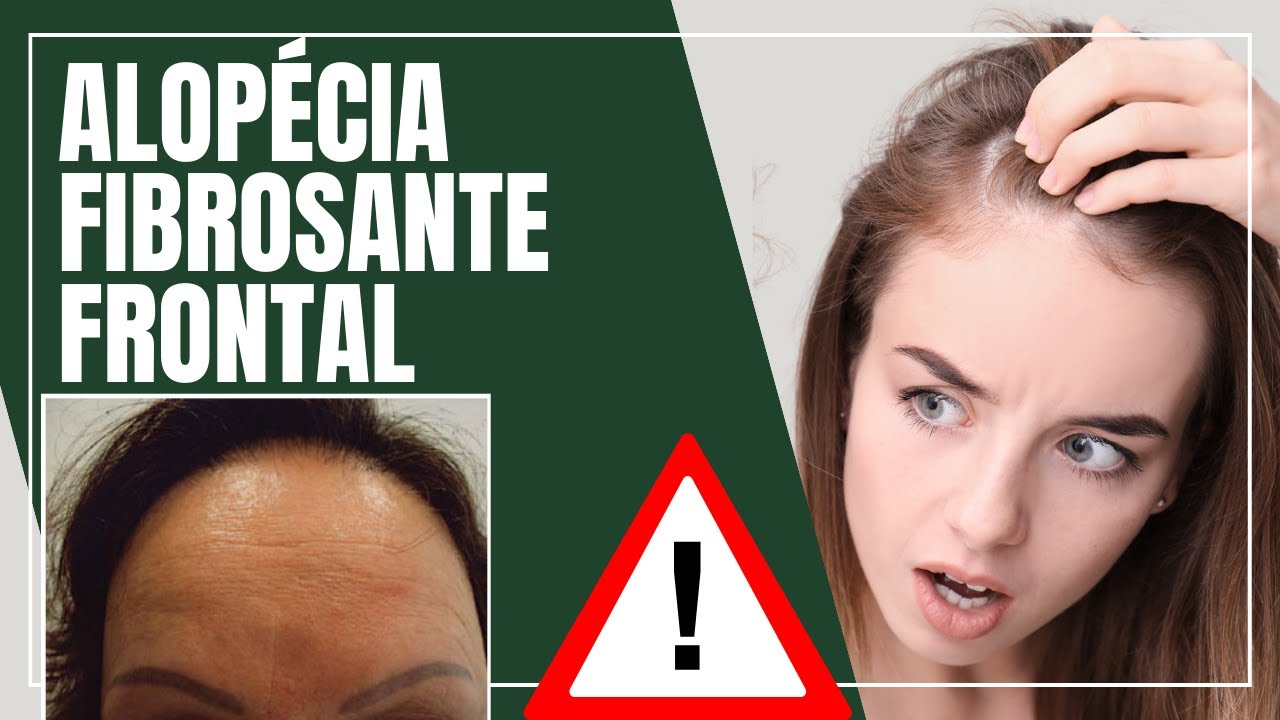 Alopecia Fibrosante Frontal: tudo o que você precisa saber