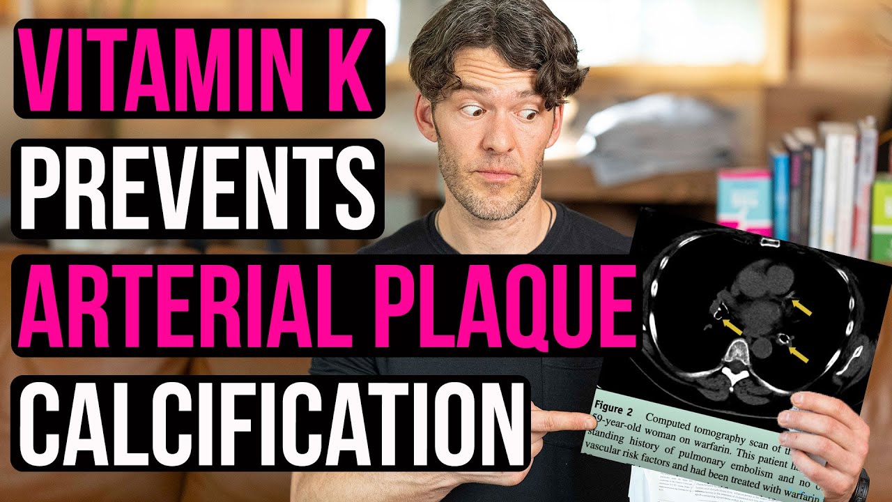Vitamin K2 Prevents Arterial Calcification: Must Know-Science