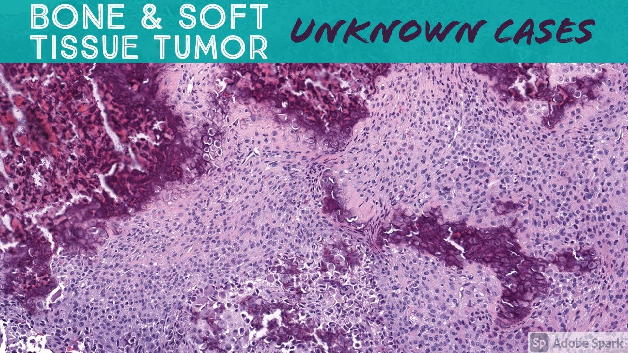 Soft Tissue & Bone Tumor Pathology Unknown Cases (Yale) (see video description for digital slides)