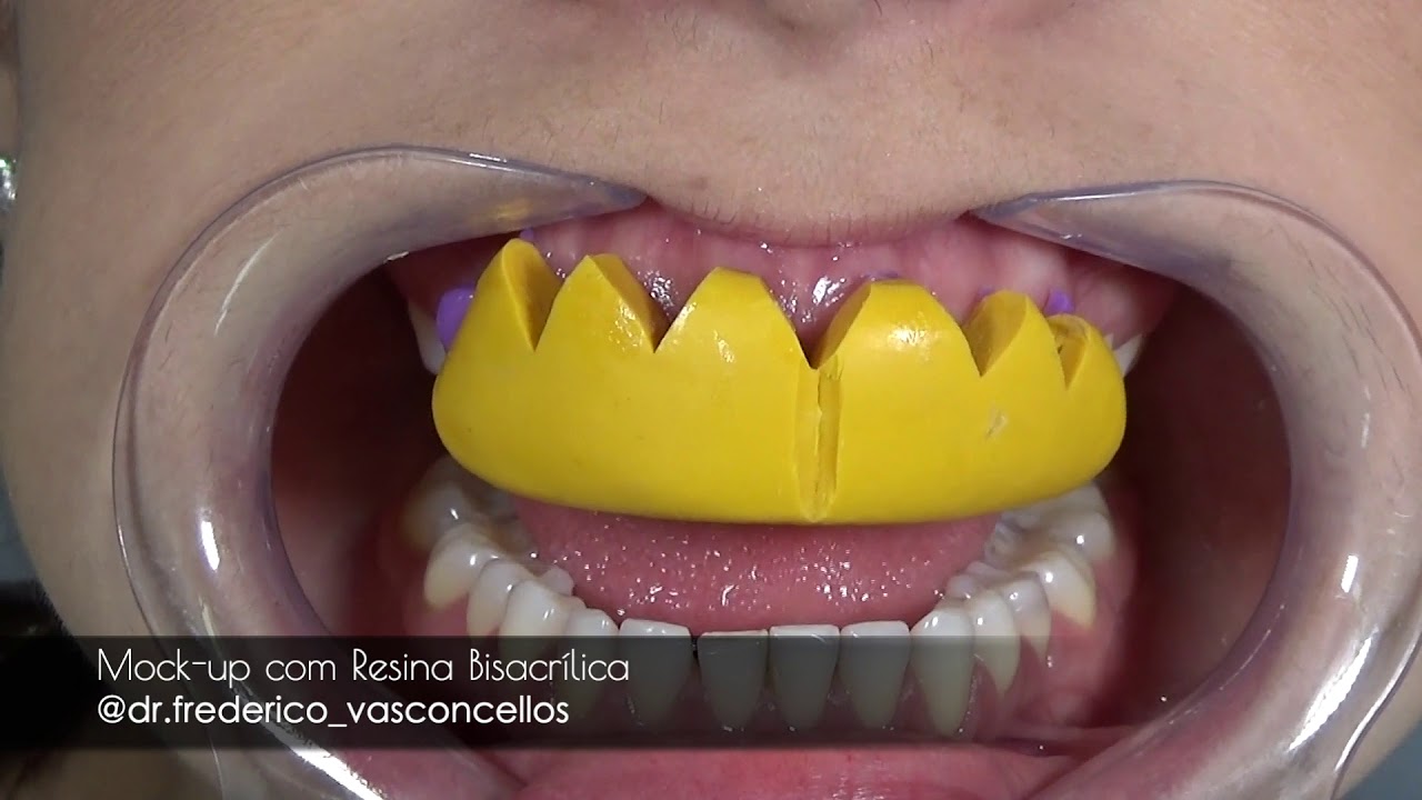 Mock up com resina bisacrílica