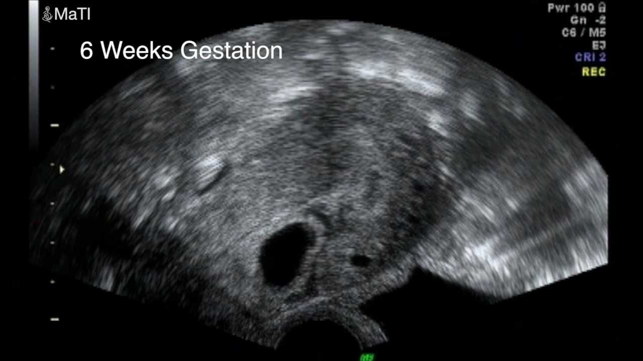 Early Pregnancy scan - Cesarean Scar Pregnancy Video 1