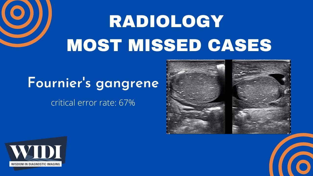 Most Missed Cases: Fournier's Gangrene